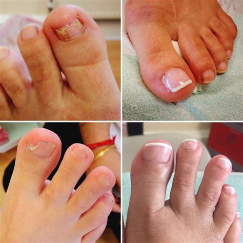 wilde pedique toenail restoration.